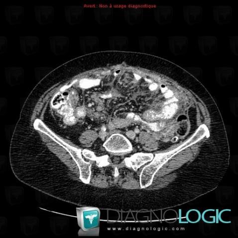 Lymphoma, Mesentery / Peritoneum, CT