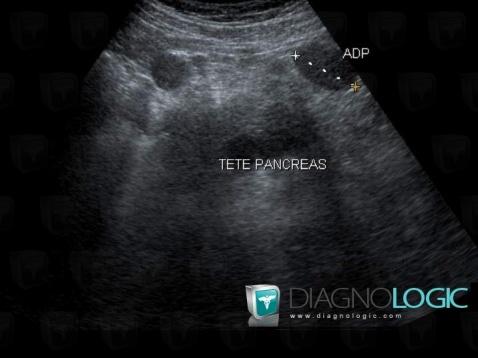 Lymphoma, Mesentery / Peritoneum, US