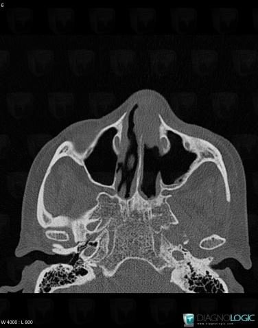 Lymphoma, Nasal cavity / Nasopharynx, CT