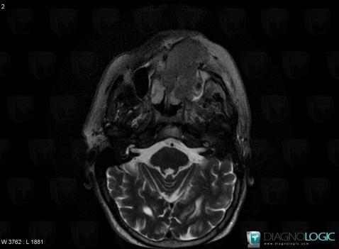 Lymphoma, Nasal cavity / Nasopharynx, MRI
