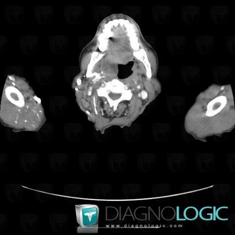 Lymphoma, Oropharynx / Floor-mouth, CT