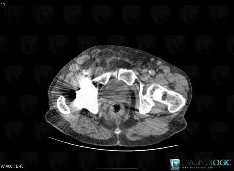 Lymphoma, Other soft tissues/nerves - Pelvis, CT