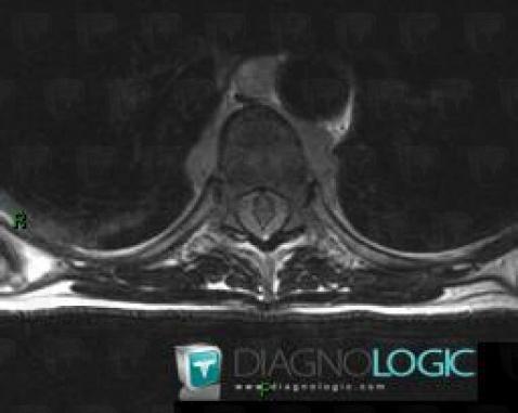 Lymphoma, Paraspinal, MRI