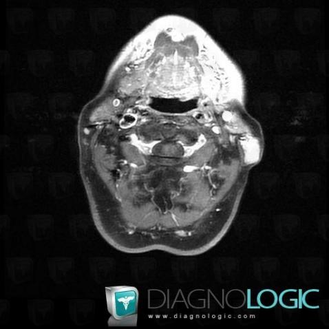 Lymphoma, Parotid and other salivary glands, MRI