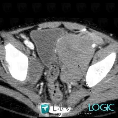 Lymphoma, Pelvis / Perineum, CT