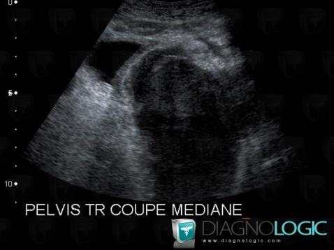 Lymphoma, Pelvis / Perineum, US