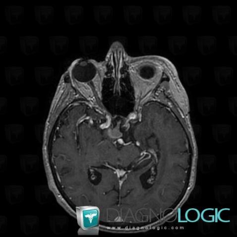 Lymphoma, Pituitary gland and parasellar region, MRI