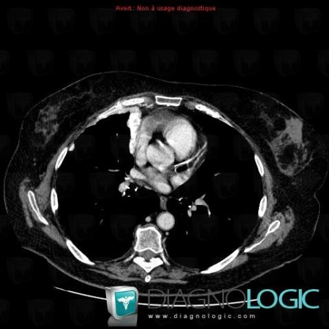 Lymphoma, Pleura, CT