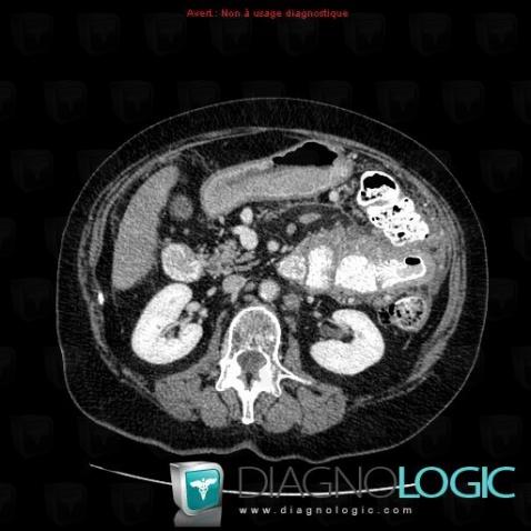 Lymphoma, Pleura, Small bowel, CT