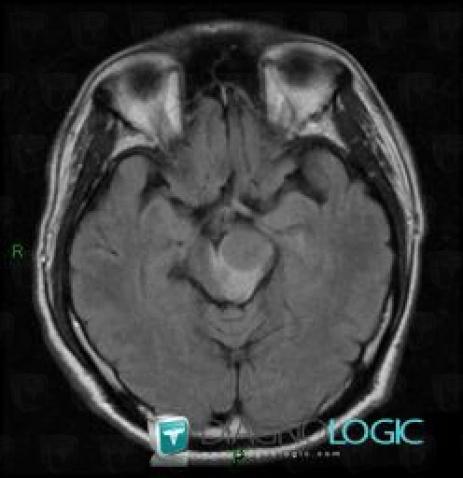 Lymphoma, Posterior fossa, MRI