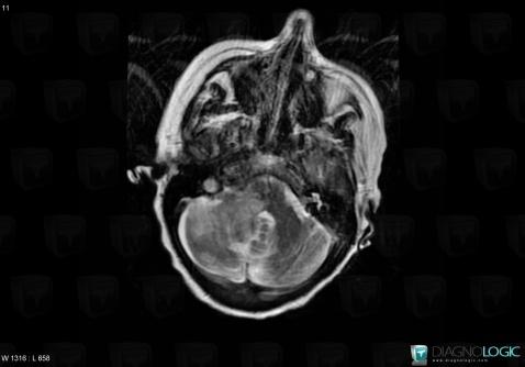 Lymphoma, Posterior fossa, MRI