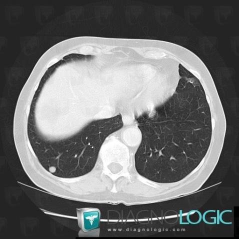 Lymphoma, Pulmonary parenchyma, CT