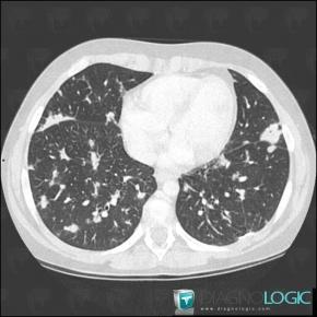 Lymphoma, Pulmonary parenchyma, CT