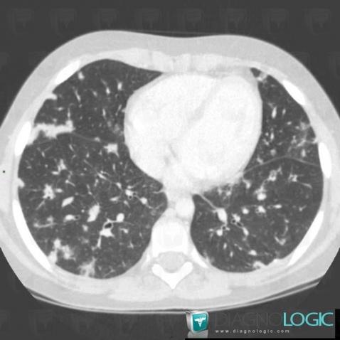 Lymphoma, Pulmonary parenchyma, CT