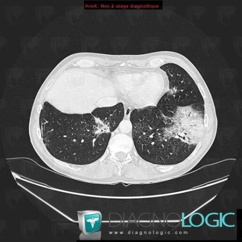 Lymphoma, Pulmonary parenchyma, CT