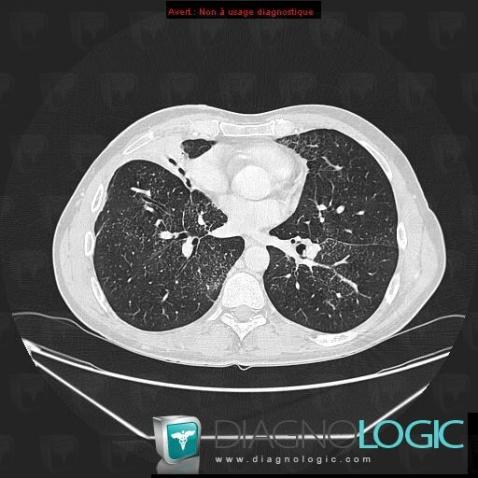 Lymphoma, Pulmonary parenchyma, CT