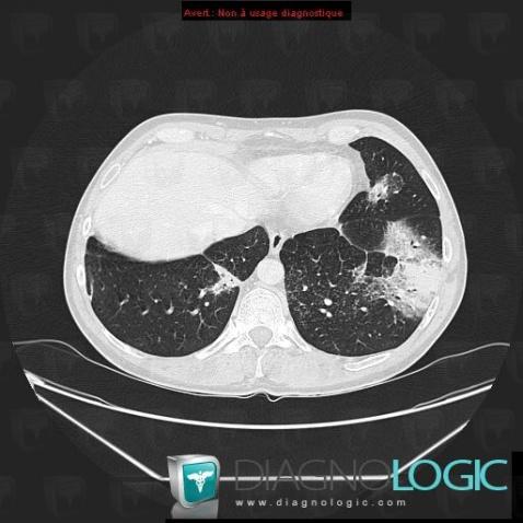 Lymphoma, Pulmonary parenchyma, CT