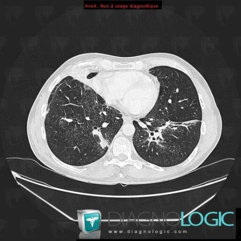 Lymphoma, Pulmonary parenchyma, CT