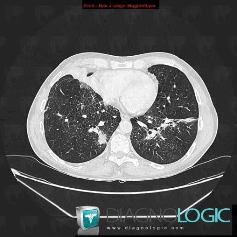 Lymphoma, Pulmonary parenchyma, CT