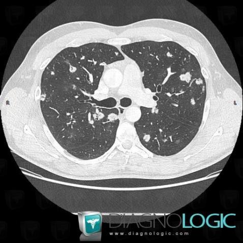 Lymphoma, Pulmonary parenchyma, CT