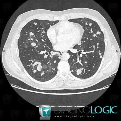 Lymphoma, Pulmonary parenchyma, CT