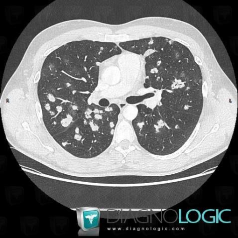 Lymphoma, Pulmonary parenchyma, CT