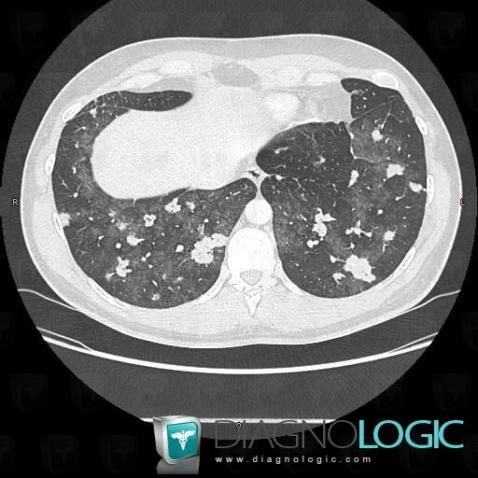 Lymphoma, Pulmonary parenchyma, CT