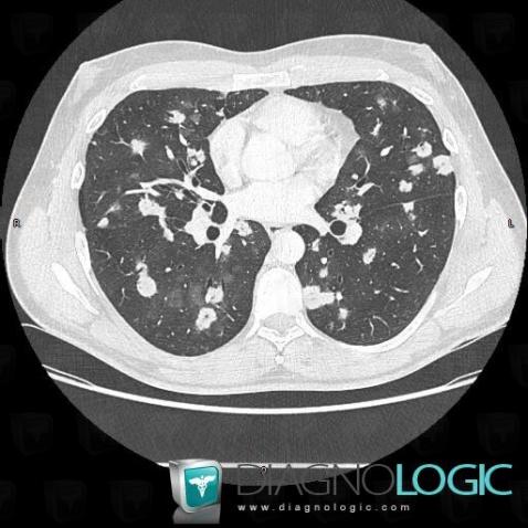 Lymphoma, Pulmonary parenchyma, CT