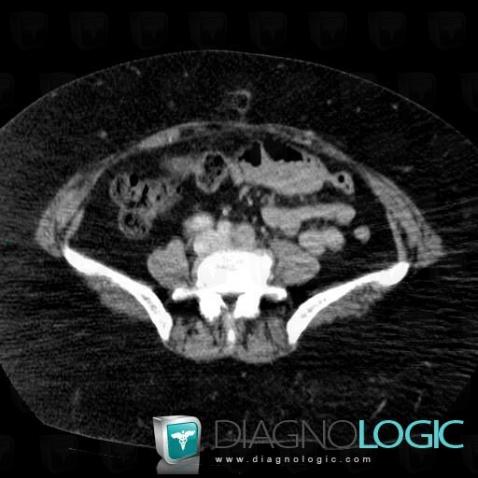 Lymphoma, Retroperitoneum, CT