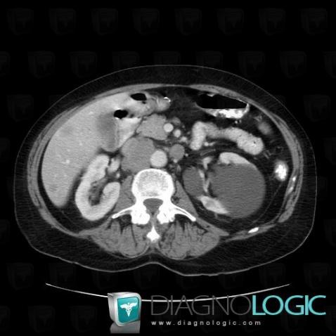 Lymphoma, Retroperitoneum, CT