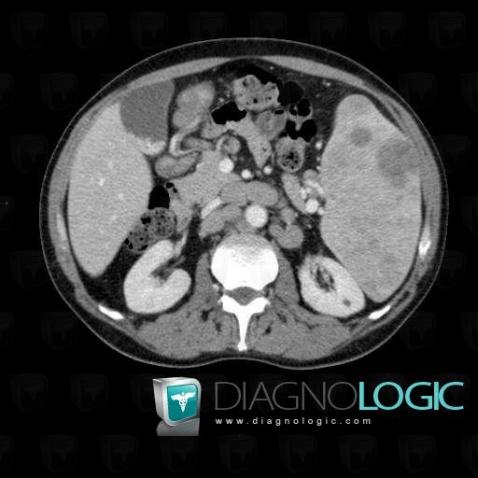 Lymphoma, Retroperitoneum, CT