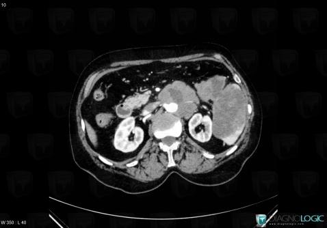 Lymphoma, Retroperitoneum, CT