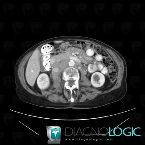 Lymphoma, Retroperitoneum, CT