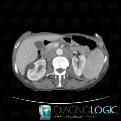Lymphoma, Retroperitoneum, CT