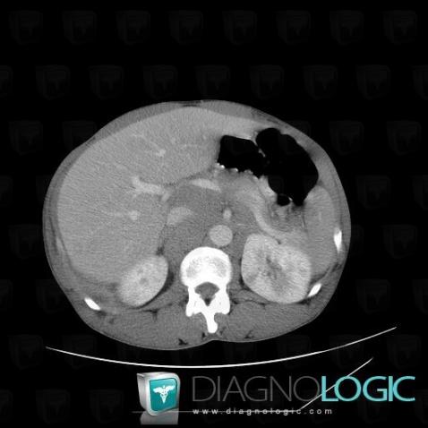 Lymphoma, Retroperitoneum, CT