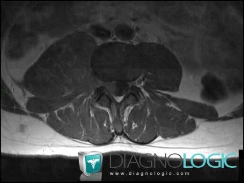 Lymphoma, Retroperitoneum, Paraspinal, MRI