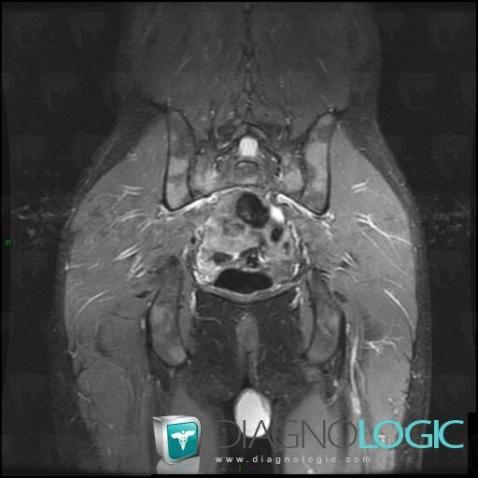 Lymphoma, Sacrum / Coccyx, MRI