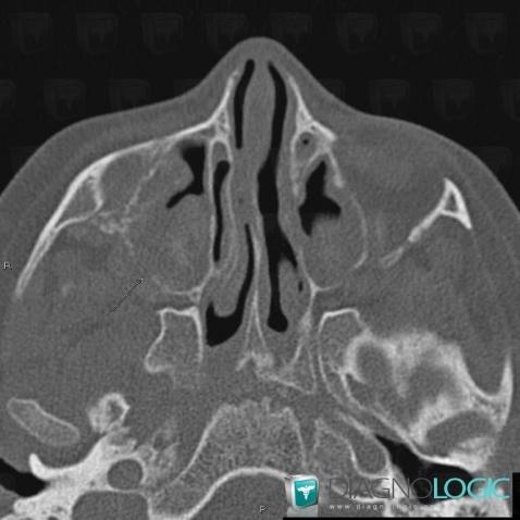 Radiology case : Lymphoma (CT) - Diagnologic