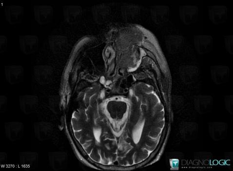 Lymphoma, Sinus, MRI