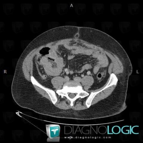 Lymphoma, Small bowel, CT