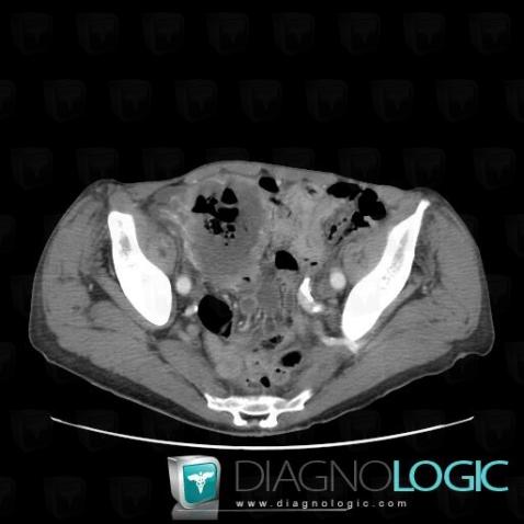 Lymphoma, Small bowel, CT
