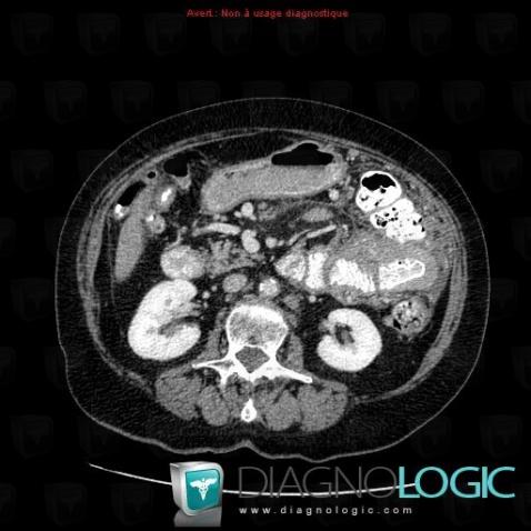 Lymphoma, Small bowel, CT