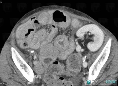 Lymphoma, Small bowel, CT