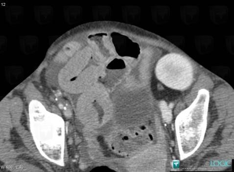 Lymphoma, Small bowel, CT