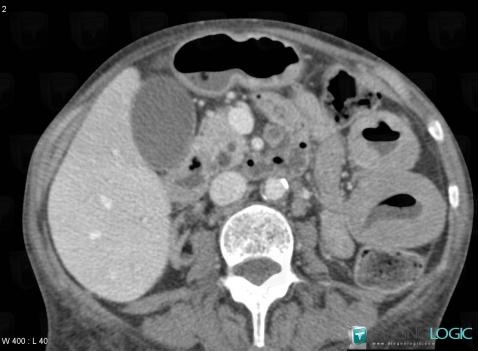 Lymphoma, Small bowel, CT