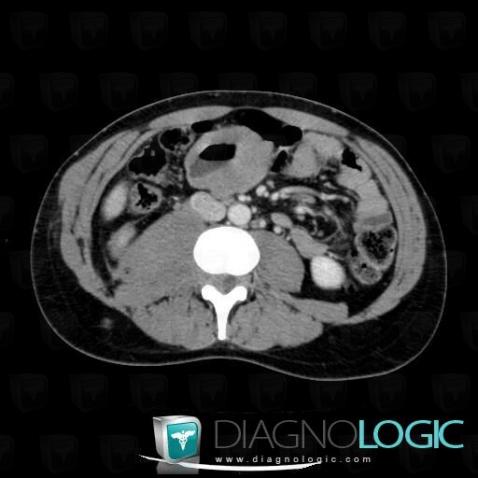 Lymphoma, Small bowel, Retroperitoneum, CT