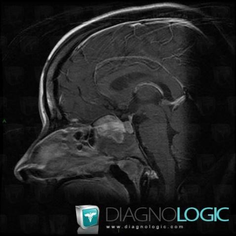 Lymphoma, Sphenoid bone, MRI