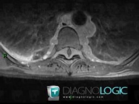 Lymphoma, Spinal canal / Cord, MRI