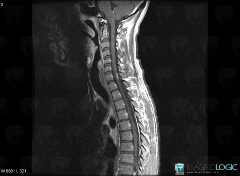 Lymphoma, Spinal canal / Cord, MRI