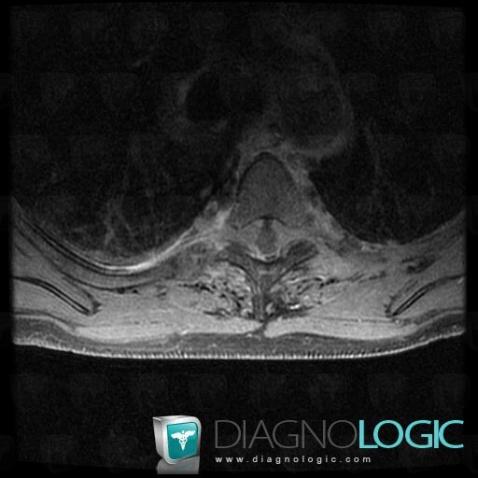 Lymphoma, Spinal canal / Cord, MRI